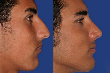 rhinoplasty before and after orange county