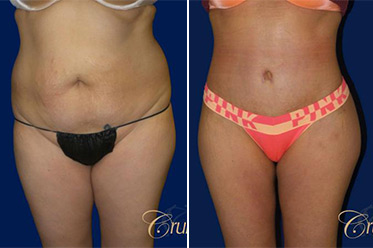 tummy tuck before and after orange county