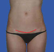 Mini Abdominoplasty Incision. Notice how low and short the incision can ideally be positioned.