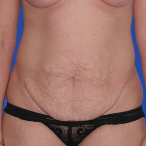 abdominoplasty-Before2 (1)