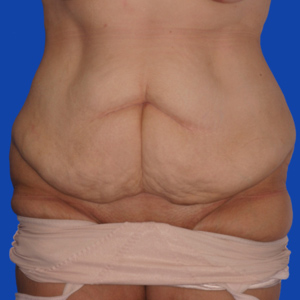 abdominoplasty-Before8