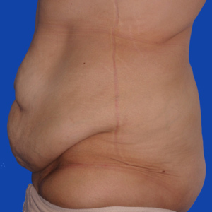abdominoplasty-Before9