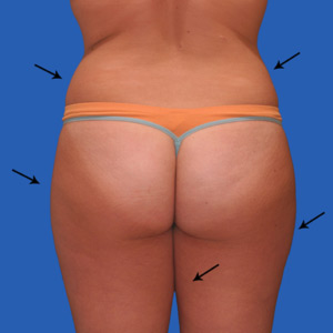 liposuction_before