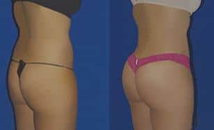 Orange County Brazilian Butt Lift Patients Report Improved Skin