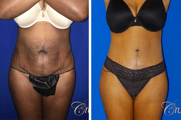 tummy tuck before and after orange county