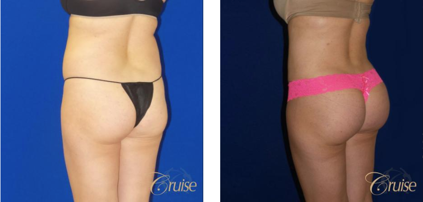 What to Know When Considering a Brazilian Butt Lift