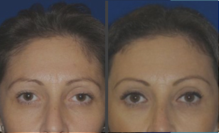 blepharoplasty before and after results