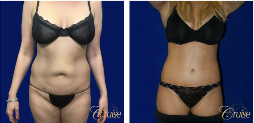 Get the Best Tummy Tuck Results, Orange County