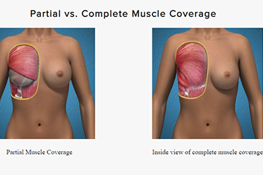 Breast Implants Under the Muscle vs Over: What's the Difference