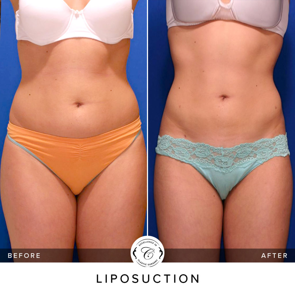 Is Liposuction My Only Option for Body Contouring?, Liposuction Newport  Beach