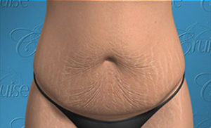 Monsplasty helps flatten the lower bulge under the belly & above