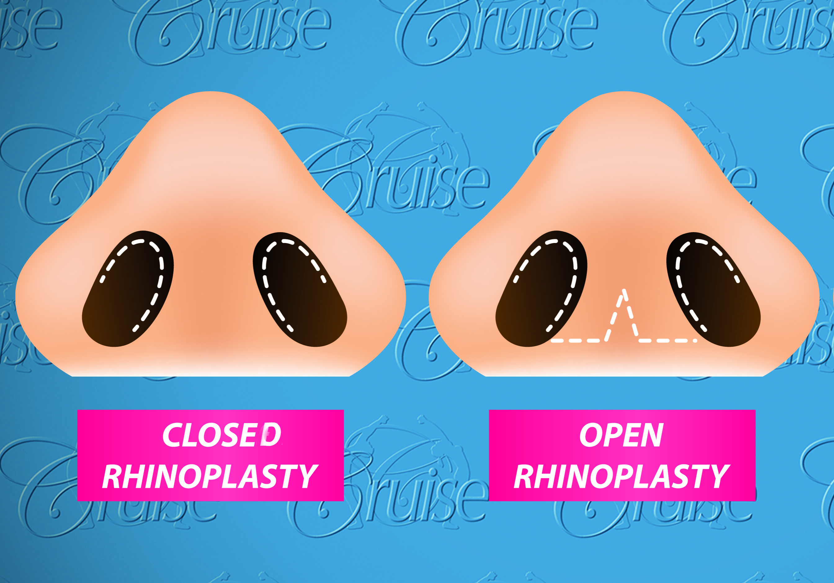 Open and Closed Rhinoplasty