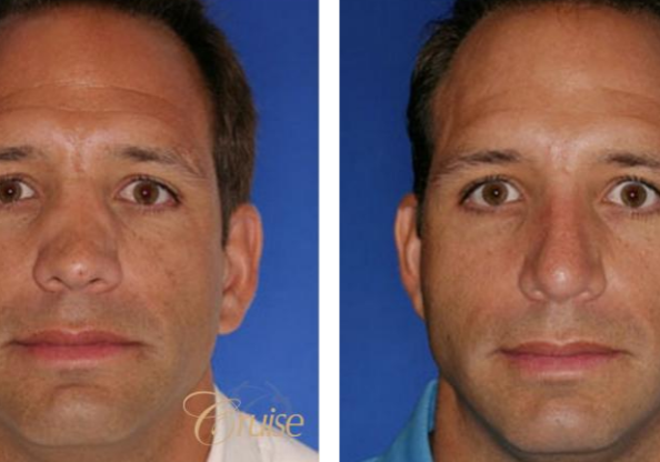 rhinoplasty before and after orange county ca
